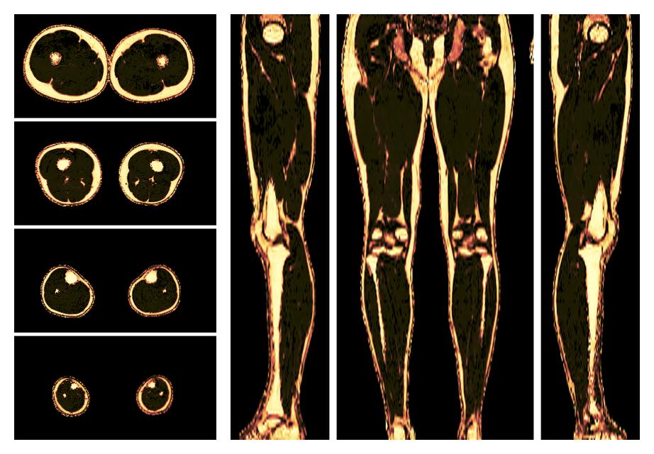 The fat fraction of the lower extremity obtained from the dixon reconstruction for muscle water fat quantification.